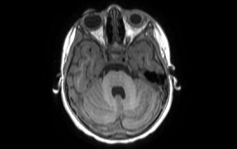 Acute necrotizing encephalitis of childhood (Radiopaedia 67356-76737 Axial T1 70).jpg