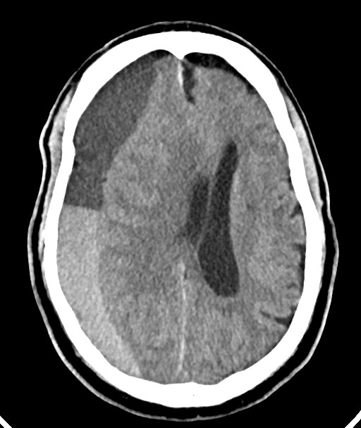 Acute on chronic subdural hematoma (Radiopaedia 78346-90966 Axial non-contrast 37).jpg