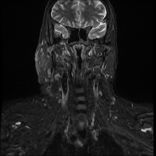 File:Acute otitis externa (Radiopaedia 57296-64236 Coronal STIR 9).jpg