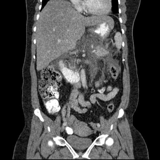 File:Acute pancreatitis (Radiopaedia 20829-20744 Coronal C+ portal venous phase 28).jpg