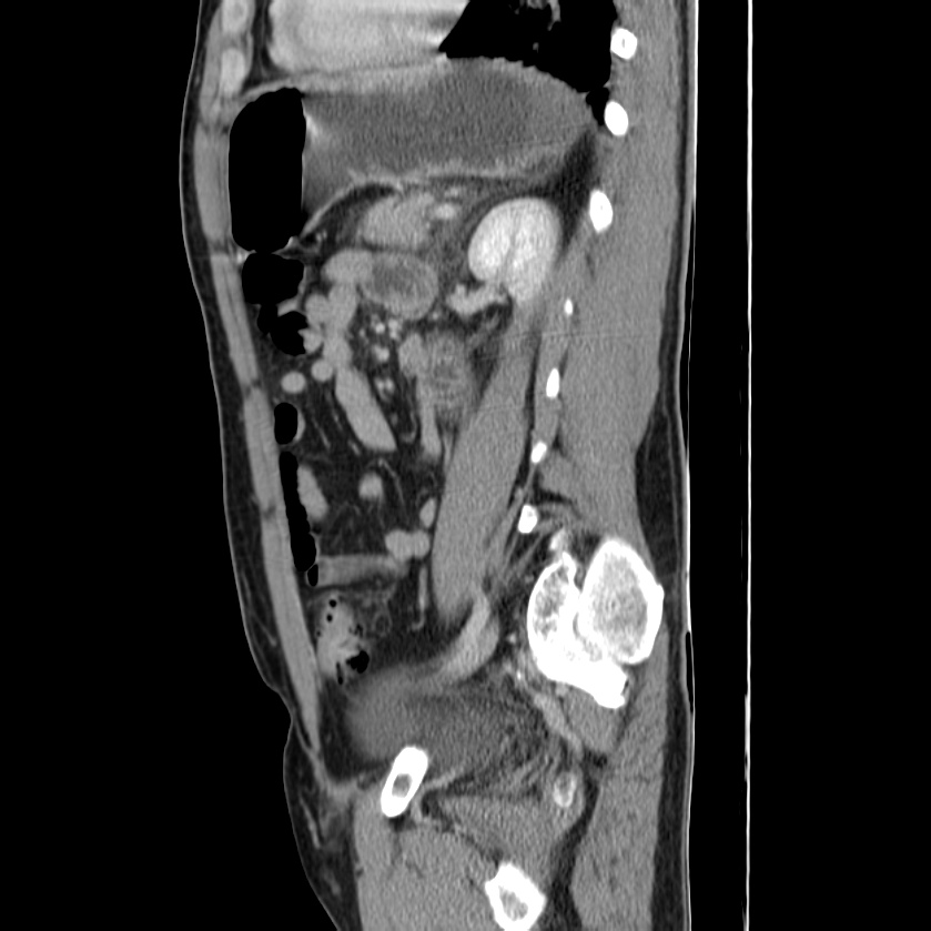 Acute pancreatitis (Radiopaedia 22572-22596 Sagittal C+ portal venous phase 36).jpg