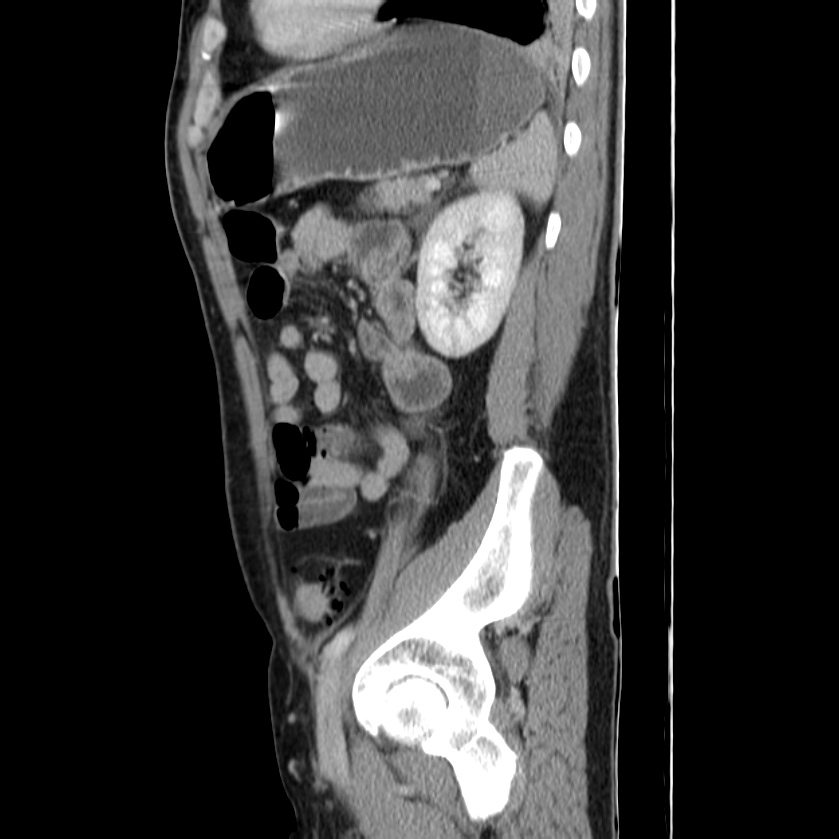 Acute pancreatitis (Radiopaedia 22572-22596 Sagittal C+ portal venous phase 40).jpg