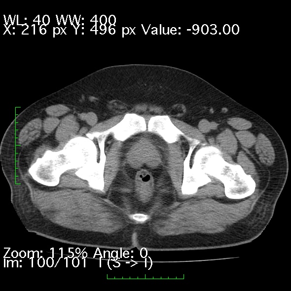 Acute pancreatitis (Radiopaedia 34043-35276 Axial non-contrast 100).jpg