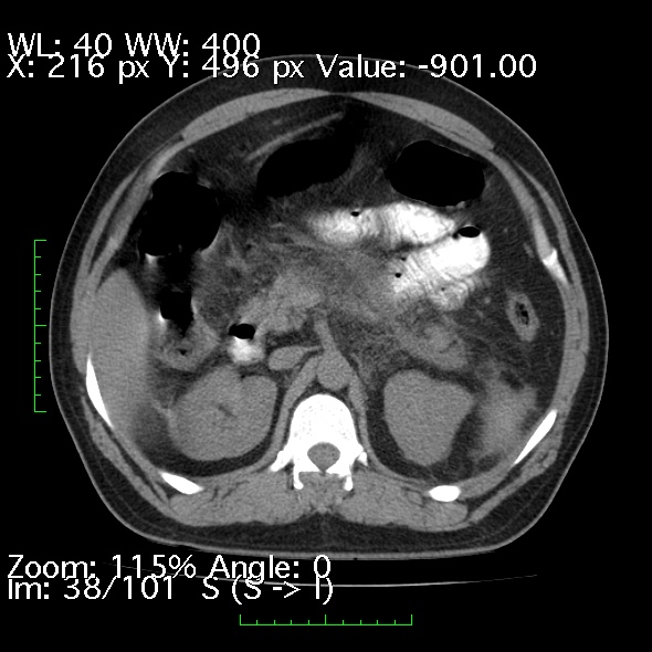 Acute pancreatitis (Radiopaedia 34043-35276 Axial non-contrast 38).jpg