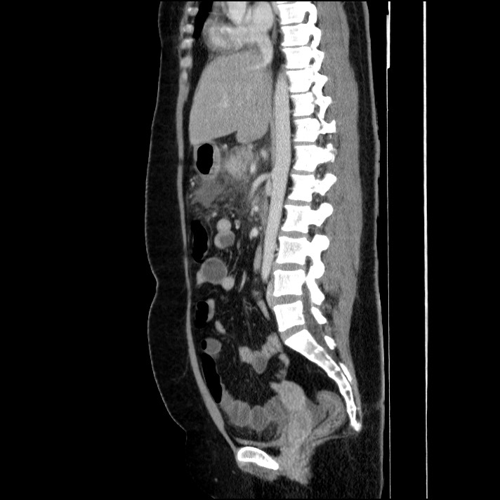 Acute pancreatitis (Radiopaedia 69236-79012 Sagittal C+ portal venous phase 52).jpg