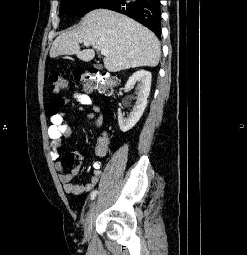 Acute pancreatitis (Radiopaedia 85390-101010 Sagittal C+ portal venous phase 30).jpg