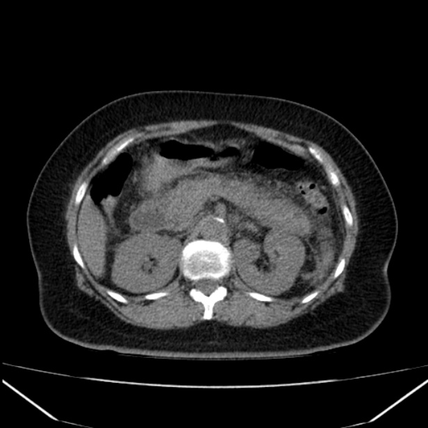 Acute pancreatitis - Balthazar C (Radiopaedia 26569-26714 Axial non-contrast 35).jpg