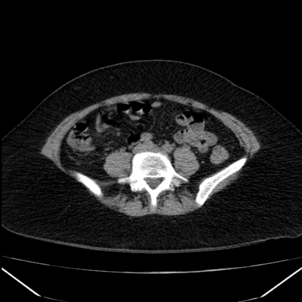Acute pancreatitis - Balthazar C (Radiopaedia 26569-26714 Coronal C+ portal venous phase 63).jpg