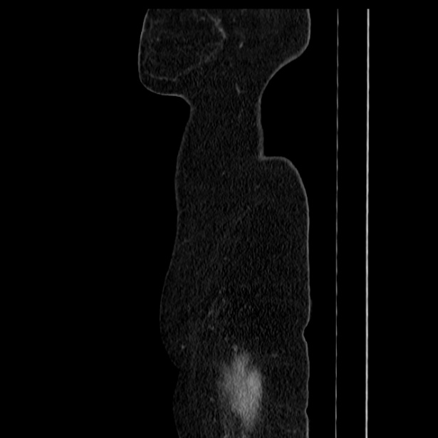 Acute pancreatitis - Balthazar C (Radiopaedia 26569-26714 Sagittal C+ portal venous phase 67).jpg