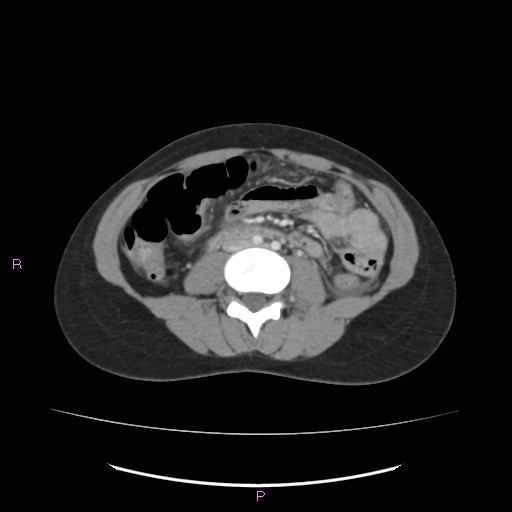 Acute pancreatitis secondary to stone at minor papilla and pancreatic divisum (Radiopaedia 76570-88333 Axial C+ portal venous phase 42).jpg