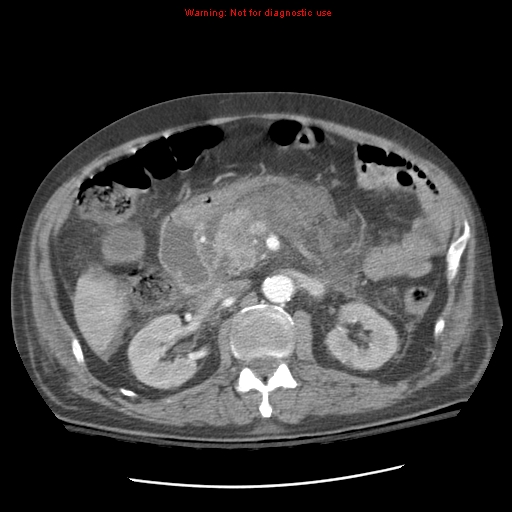 File:Acute pancreatitis with incidental pancreatic lipoma (Radiopaedia 10190-10730 Axial C+ arterial phase 44).jpg