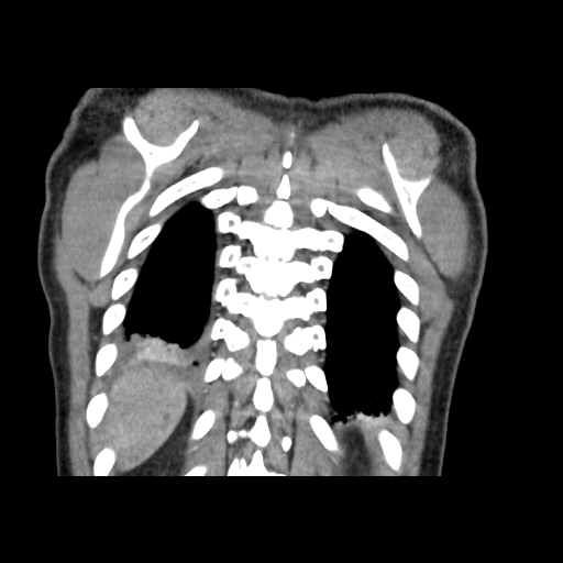 Acute segmental pulmonary emboli and pulmonary infarction (Radiopaedia 62264-70444 Coronal C+ CTPA 51).jpg