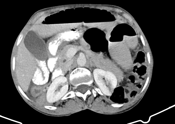File:Acute small bowel (ileal) volvulus (Radiopaedia 71740-82139 Axial C+ portal venous phase 76).jpg