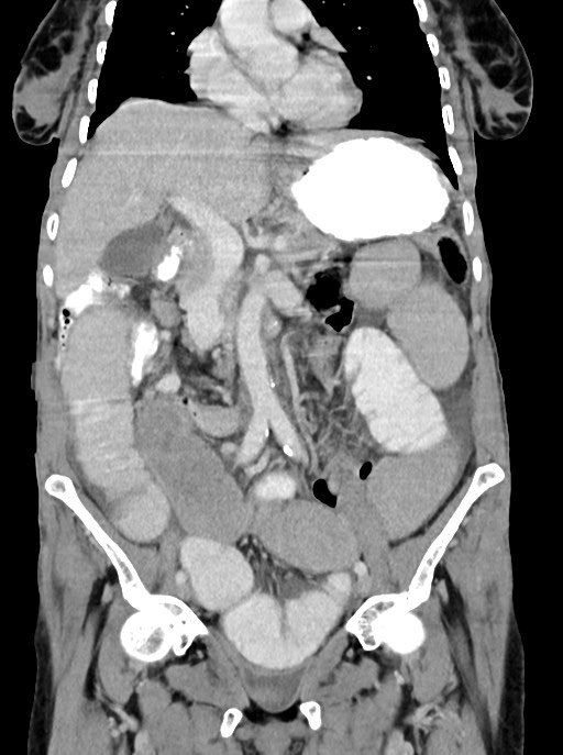 Acute small bowel (ileal) volvulus (Radiopaedia 71740-82139 Coronal C+ portal venous phase 51).jpg
