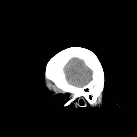 Acute subarachnoid hemorrhage and accessory anterior cerebral artery (Radiopaedia 69231-79008 Sagittal non-contrast 8).jpg