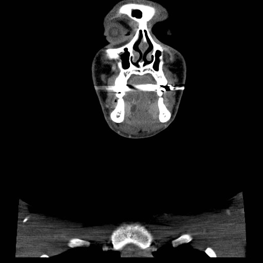 File:Acute submandibular sialadenitis secondary to ductal stone (Radiopaedia 27999-28267 D 12).jpg