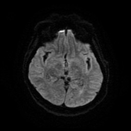 Acute superior cerebellar artery territory infarct (Radiopaedia 84104-99358 Axial DWI 18).jpg