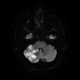 Acute superior cerebellar artery territory infarct (Radiopaedia 84104-99358 Axial DWI 58).jpg