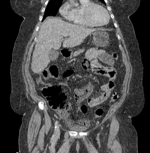 Acute superior mesenteric artery occlusion (Radiopaedia 51288-56960 Coronal C+ portal venous phase 30).jpg