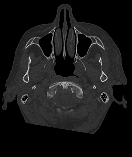 Acute traumatic subdural hematoma (Radiopaedia 82921-97257 Axial bone window 98).jpg
