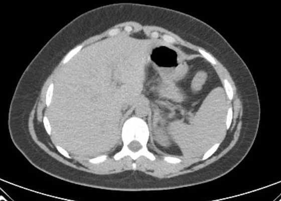 Acute unilateral nonhemorrhagic adrenal infarction (Radiopaedia 67560-76957 Axial non-contrast 17).jpg