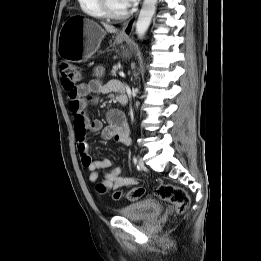 Adenocarcinoma of colon with entero-colic fistula (Radiopaedia 22832-22852 Sagittal C+ portal venous phase 38).jpg