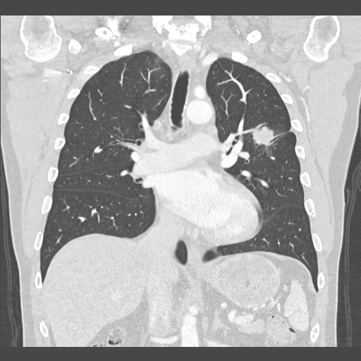 Adenocarcinoma of the lung (Radiopaedia 59871-67325 Coronal lung window 29).jpg