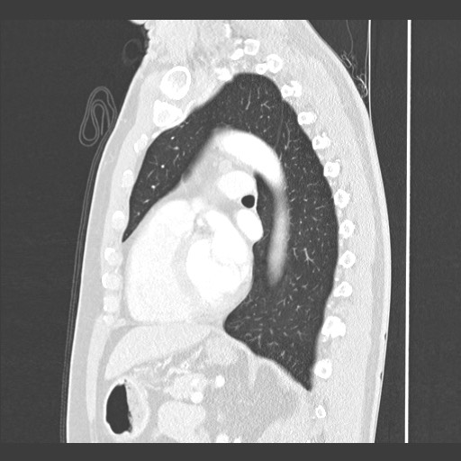Adenocarcinoma of the lung (Radiopaedia 59871-67325 Sagittal lung window 62).jpg