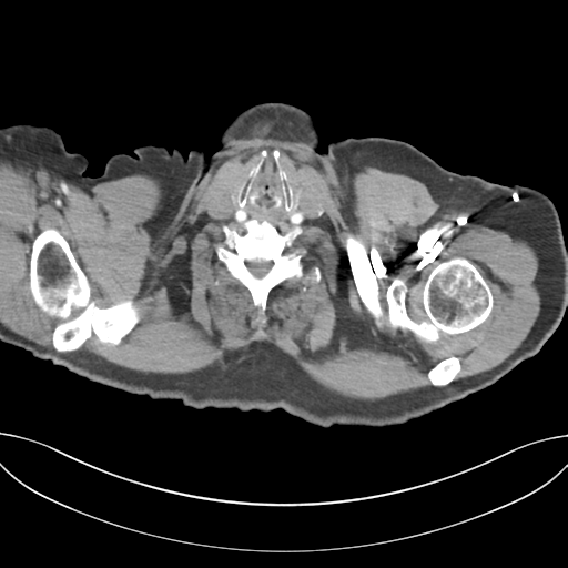Adenocarcioma of rectum- T1 lesion (Radiopaedia 36921-38547 Axial C+ arterial phase 1).png