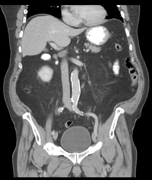 Adenocarcioma of rectum- T1 lesion (Radiopaedia 36921-38547 Coronal C+ portal venous phase 31).png