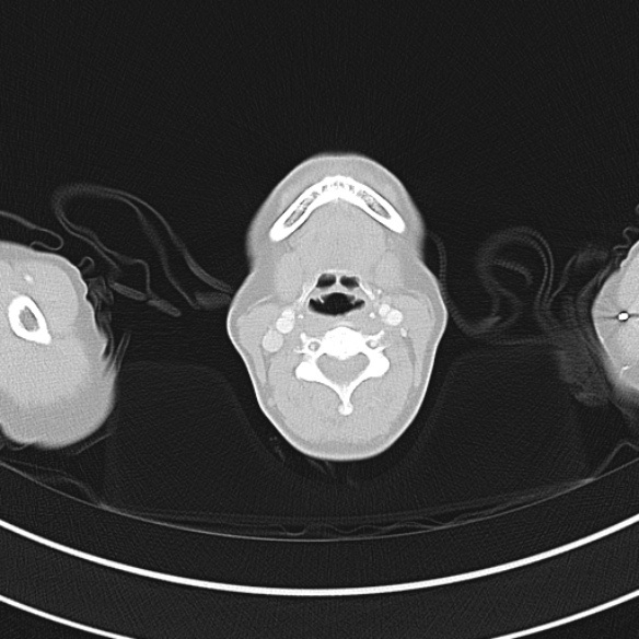 Adenocystic carcinoma of the trachea (Radiopaedia 47677-52525 Axial lung window 16).jpg