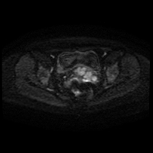 File:Adenoma malignum of cervix (Radiopaedia 66441-75705 Axial DWI 64).jpg