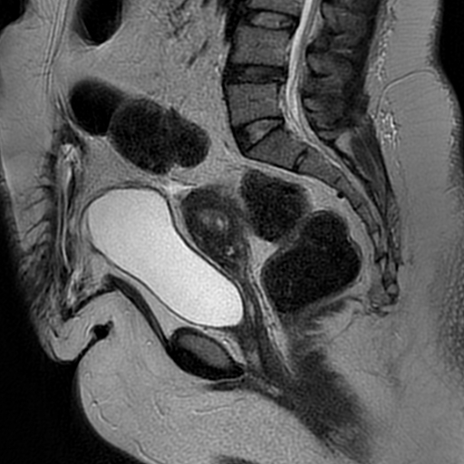 File:Adenomyosis within a didelphys uterus (Radiopaedia 70175-80215 Sagittal T2 20).jpg