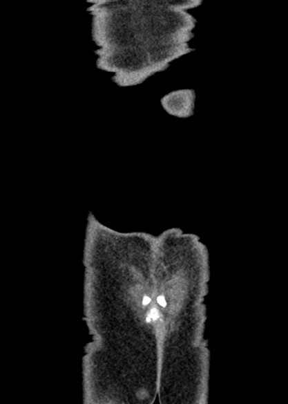 Adhesional small bowel obstruction (Radiopaedia 48397-53305 Coronal C+ portal venous phase 351).jpg