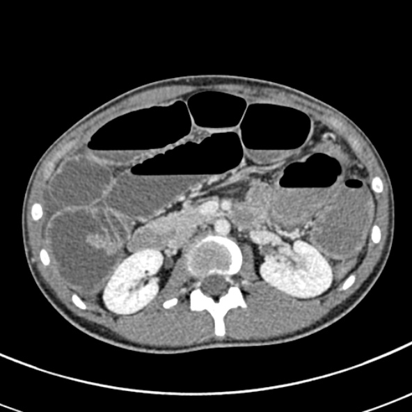 Adhesional small bowel obstruction (Radiopaedia 52107-57980 Axial C+ portal venous phase 45).jpg