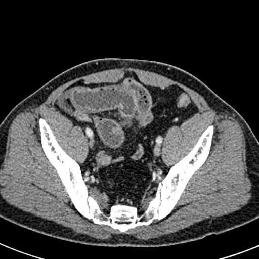 Adhesional small bowel obstruction (Radiopaedia 58900-66131 Axial C+ portal venous phase 44).jpg