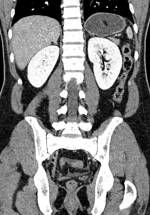 Adhesional small bowel obstruction (Radiopaedia 58900-66131 Coronal C+ portal venous phase 180).jpg