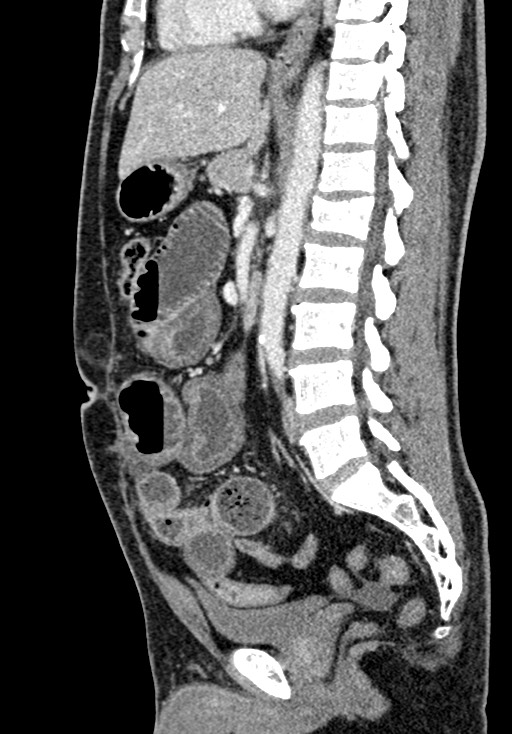 Adhesional small bowel obstruction (Radiopaedia 58900-66131 Sagittal C+ portal venous phase 132).jpg