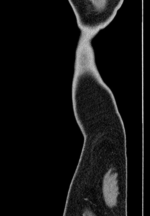 Adhesional small bowel obstruction (Radiopaedia 58900-66131 Sagittal C+ portal venous phase 254).jpg
