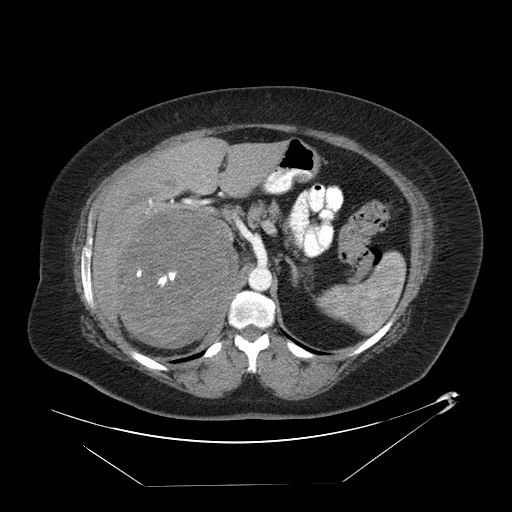 Adrenal angiosarcoma (Radiopaedia 81081-94671 Axial C+ arterial phase 23).jpg