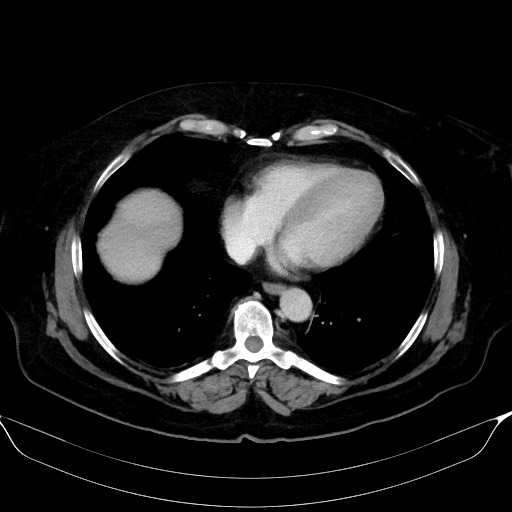 Adrenal cortical carcinoma (Radiopaedia 64017-72769 Axial C+ portal venous phase 2).jpg