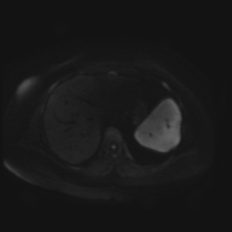 Adrenal cortical carcinoma (Radiopaedia 70906-81116 Axial DWI 34).jpg