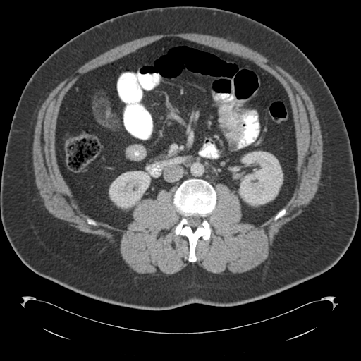 Adrenal cyst (Radiopaedia 45625-49776 Axial C+ portal venous phase 47).png