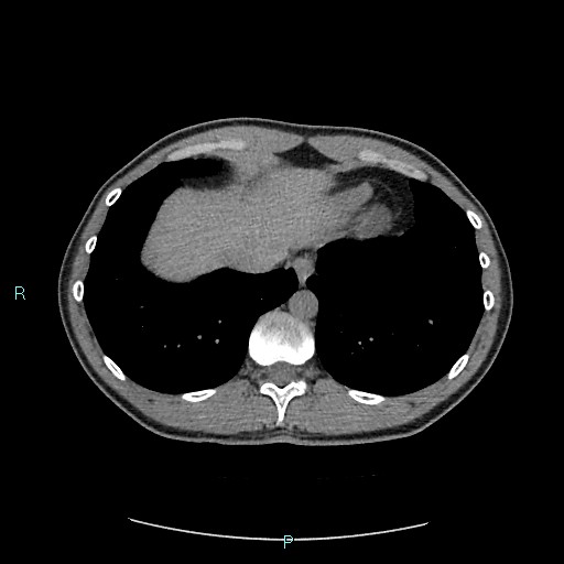 File:Adrenal cystic lymphangioma (Radiopaedia 83161-97534 Axial non-contrast 14).jpg