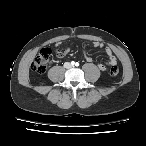 File:Adrenal gland trauma (Radiopaedia 81351-95078 Axial Dual bolus trauma C+ 89).jpg