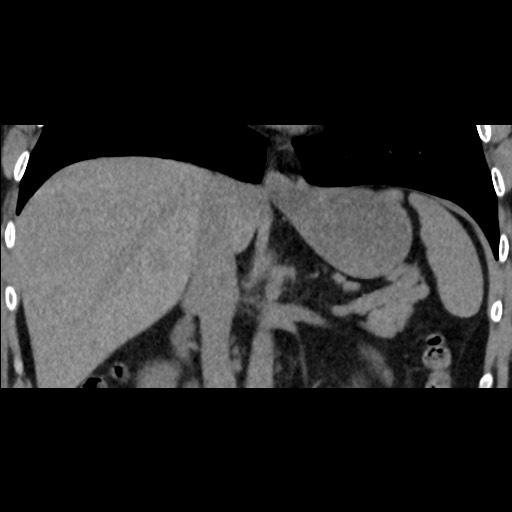 Adrenal gland trauma (Radiopaedia 81351-95079 Coronal non-contrast 48).jpg