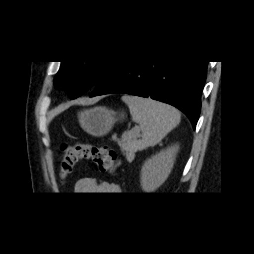 File:Adrenal gland trauma (Radiopaedia 81351-95079 Sagittal non-contrast 82).jpg