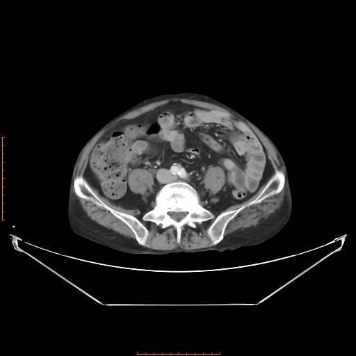 File:Adrenal hemangioma (Radiopaedia 68923-78668 Axial C+ portal venous phase 48).jpg
