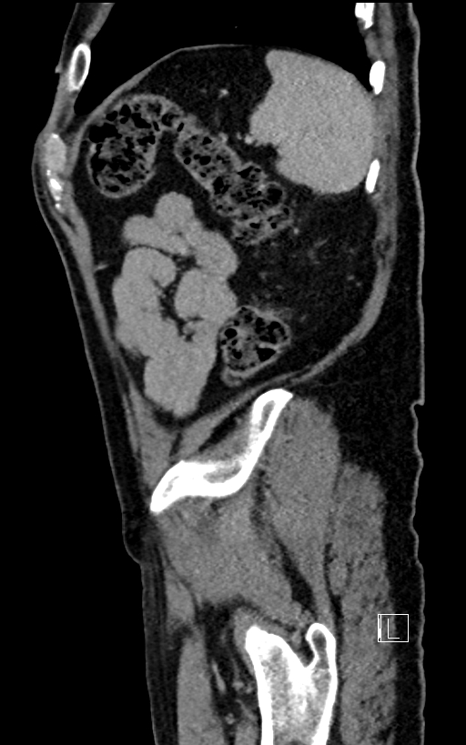Adrenal lymphoma (Radiopaedia 73730-84529 Sagittal C+ portal venous phase 95).jpg