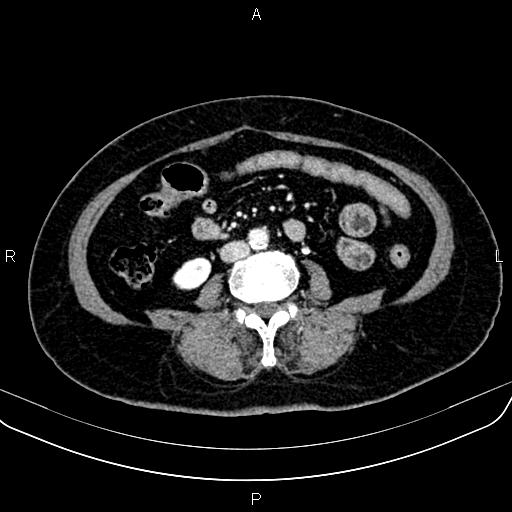 File:Adrenal myelolipoma (Radiopaedia 82742-96986 Axial renal cortical phase 102).jpg